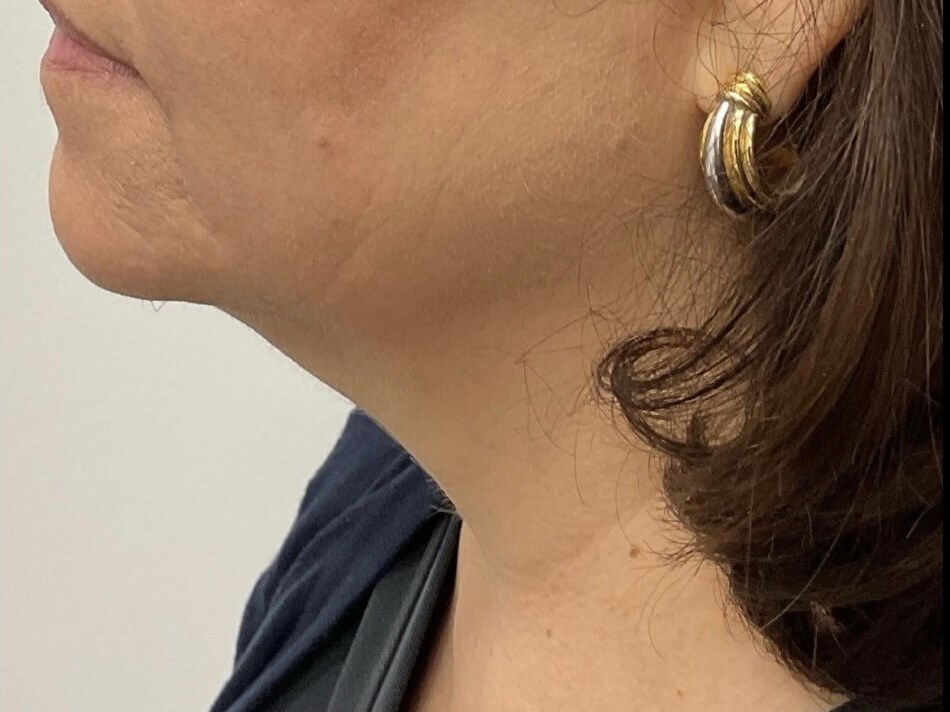 CoolSculpting Under Chin After