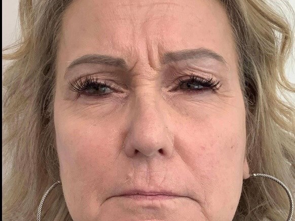 Botox for forehead Before