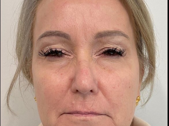 Botox for forehead After