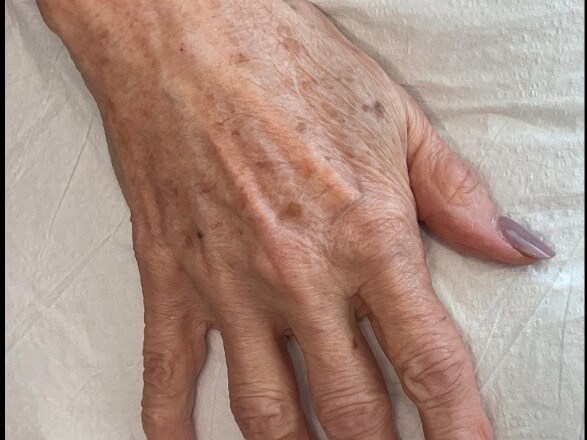 Hand Rejuvenation Before