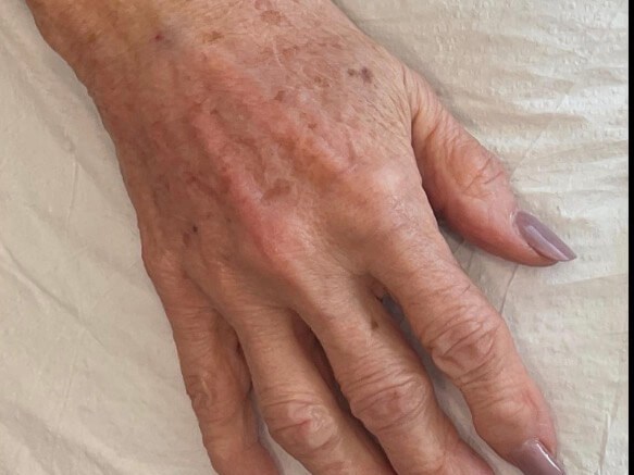 Hand Rejuvenation After