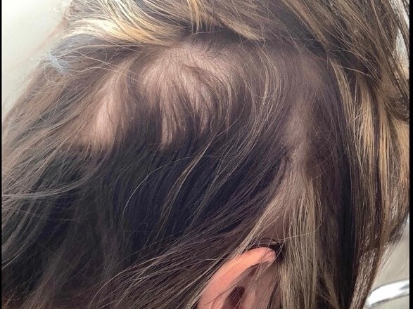PRP For Hair Loss After