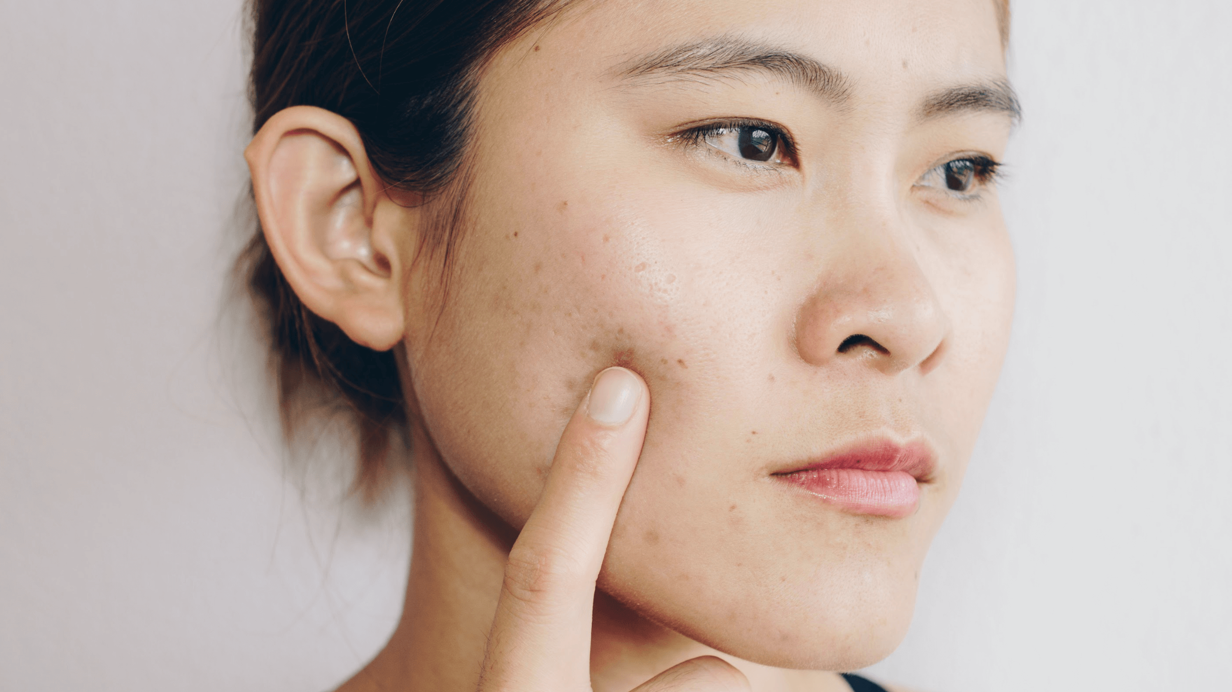 If your acne is flaring up, your brain fog is at an all time high