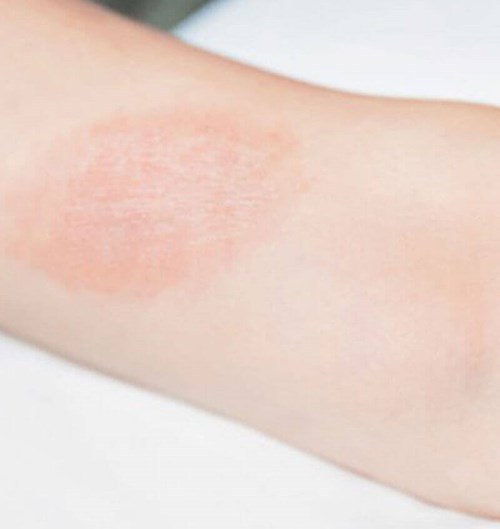 Tinea Versicolor
