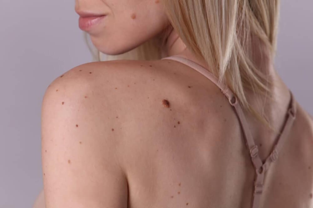 Seborrheic Keratosis (SK)  Advanced Dermatology & Skin Surgery