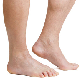 Athlete's Foot
